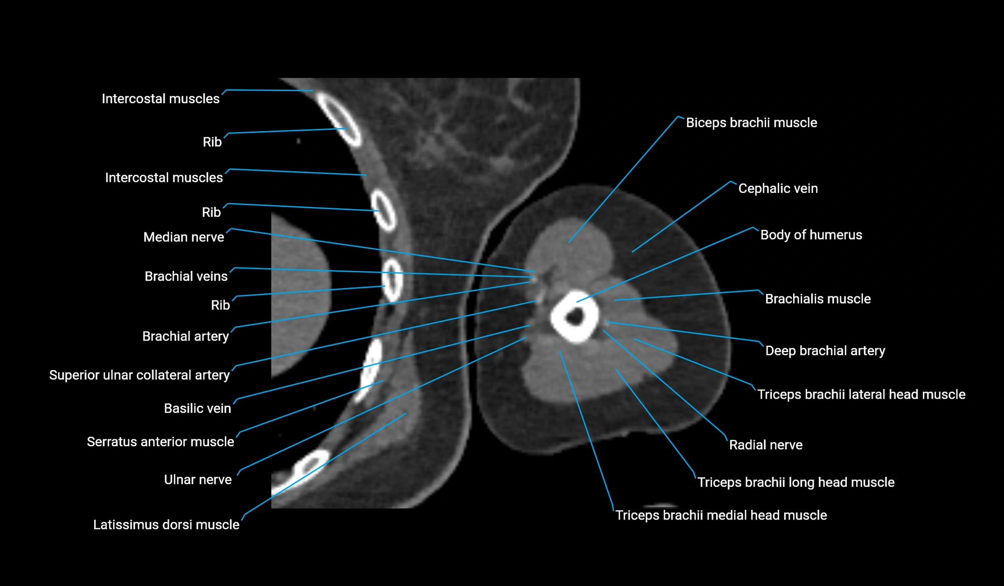 CT upper arm axial  cross sectional anatomy labelled radiology image -00254.webp